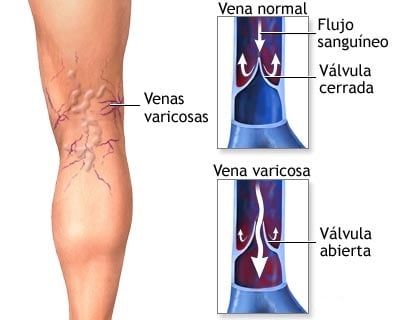 Varices: imagen explicativa de la obstrucción de una vena.