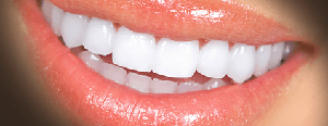 Blanqueamiento dental en casa