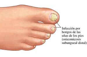 Infección por hongos en las uñas de los pies Hongos en las unas