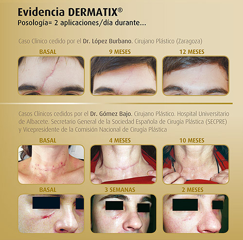 Ejemplos de uso de dermatix gel