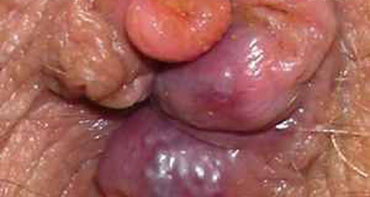 Foto de Hemorroide Externa