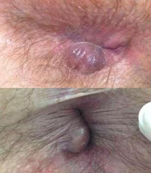 Foto de Hemorroide Interna