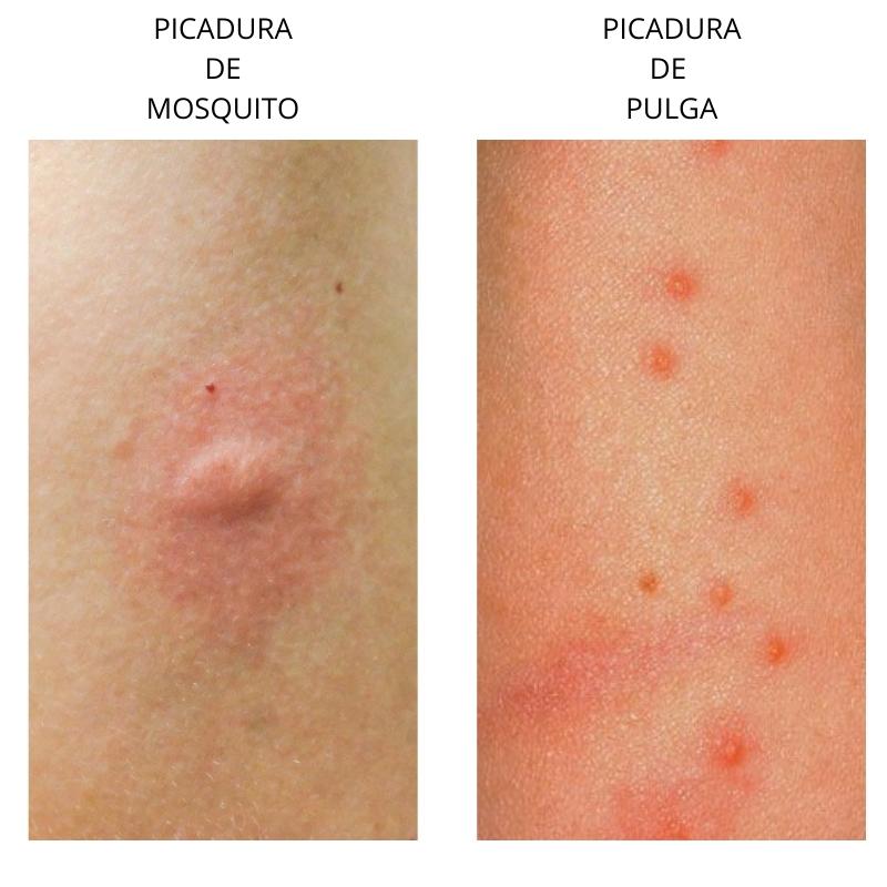 Picadura de pulga fotos