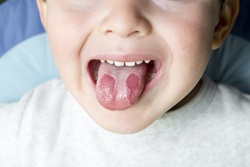 Granos en la lengua en niños