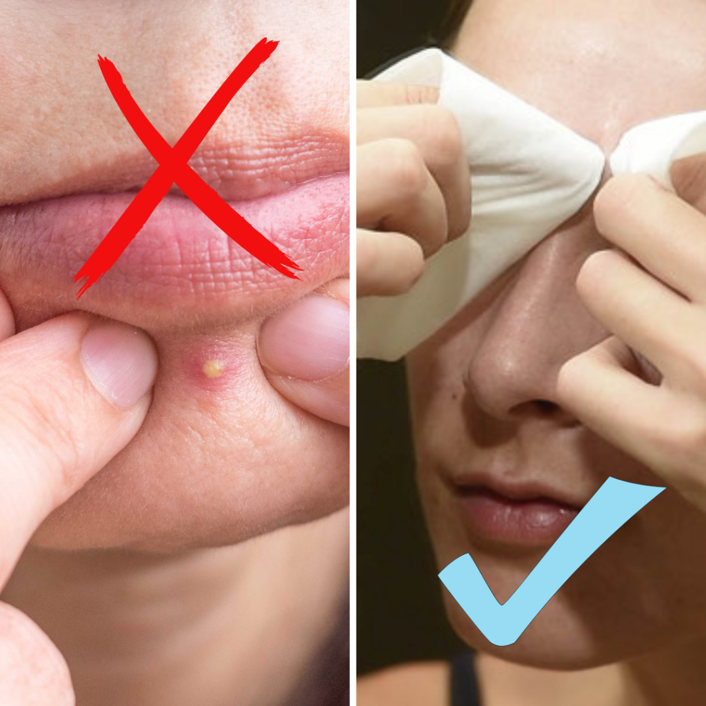 Cómo eliminar granos de la cara correctamente