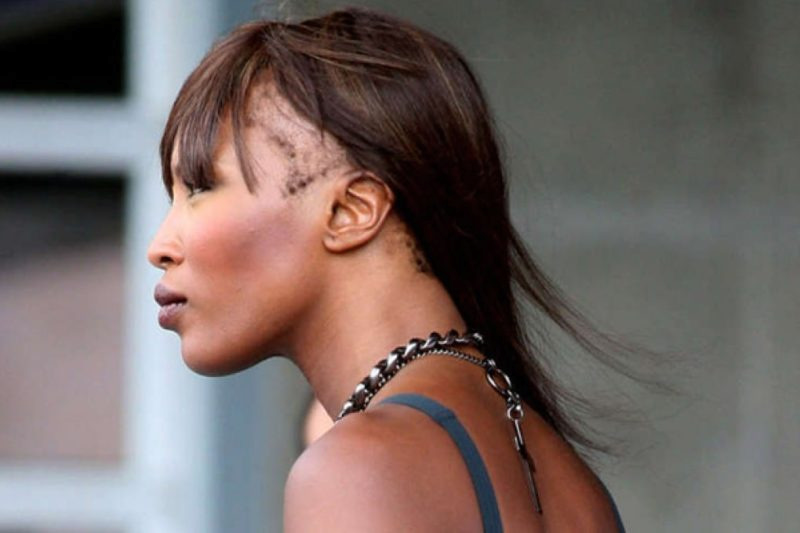 Famosas con alopecia frontal fibrosante