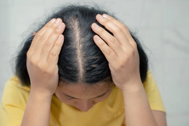 Que es alopecia