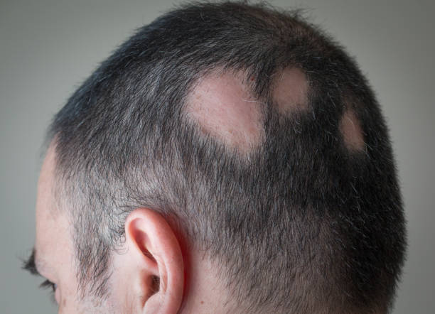 Alopecia Areata Causas