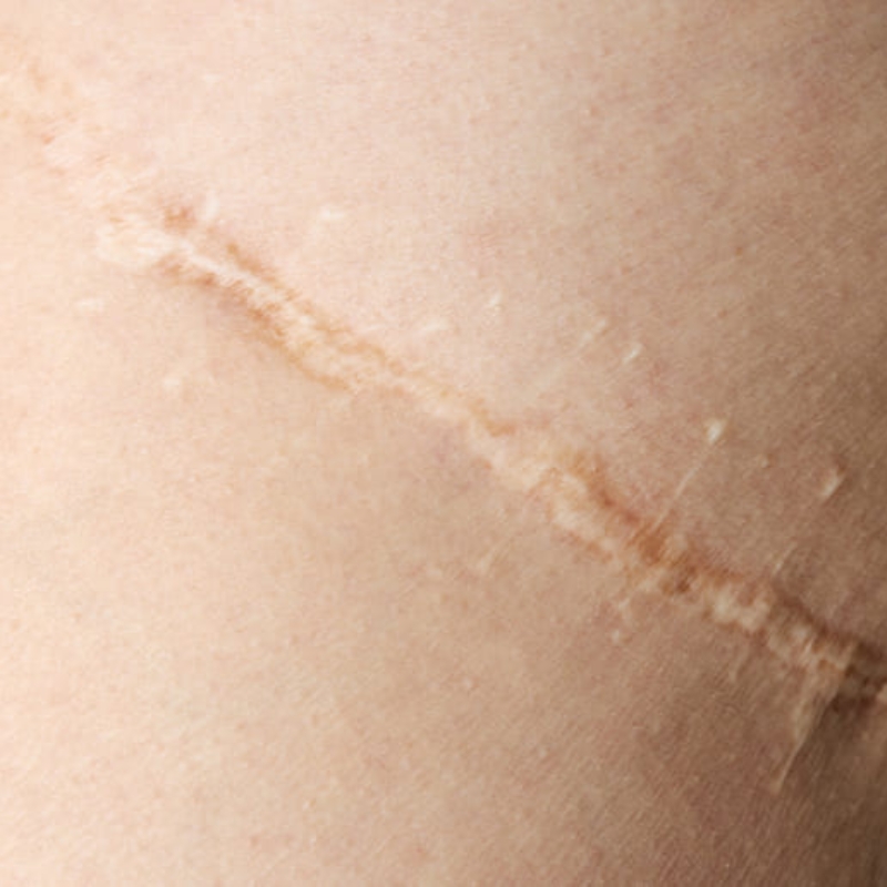 Resultados Trofolastin Cicatrices