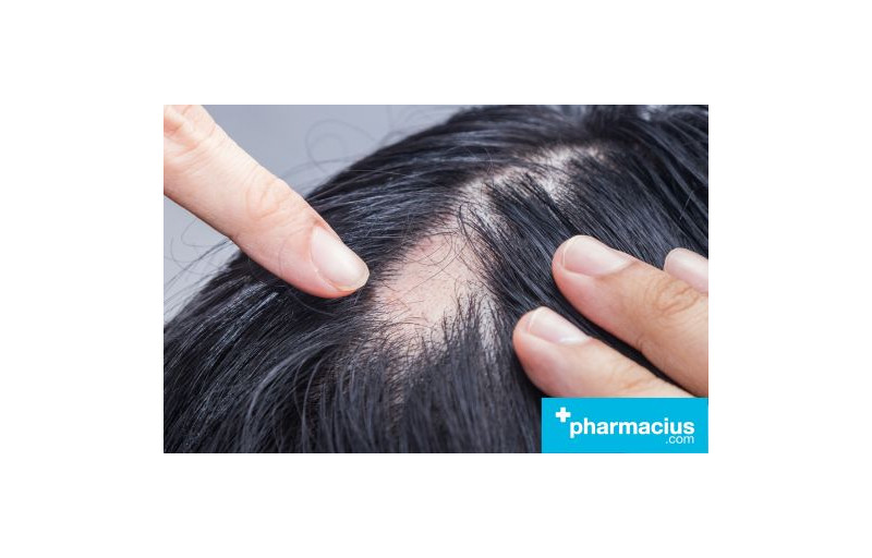 Alopecia Areata: Causas, Diferencias y FAQs