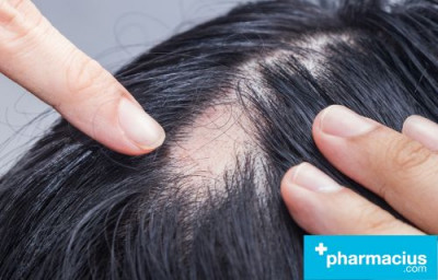 Alopecia Areata: Causas, Diferencias y FAQs