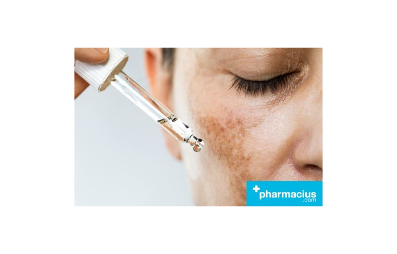 Melasma, cómo tratarla y evitarla