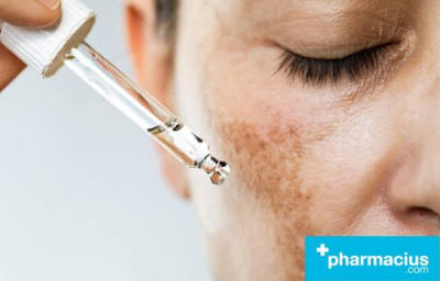 Melasma, cómo tratarla y evitarla
