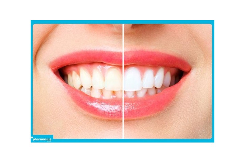 Cómo blanquear tus dientes